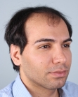 Before Hair Transplant&nbsp;Front